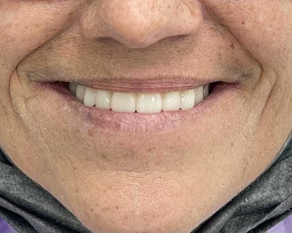 Denti Fissi in 6 Ore - Denti Carico Immediato