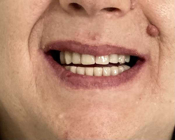 dopo