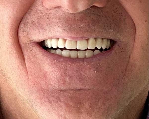 dopo