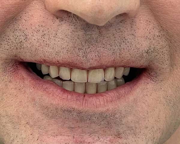 dopo