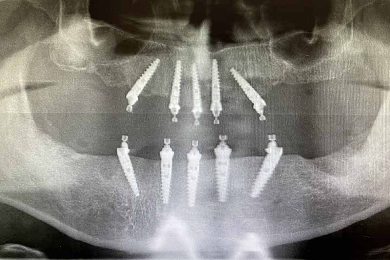 Impianto denti fissi in titanio - dentista a Brescia